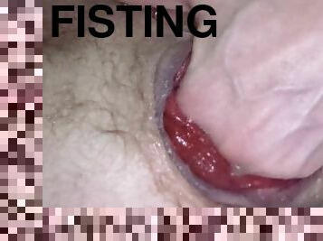 Fisting My Prolapse